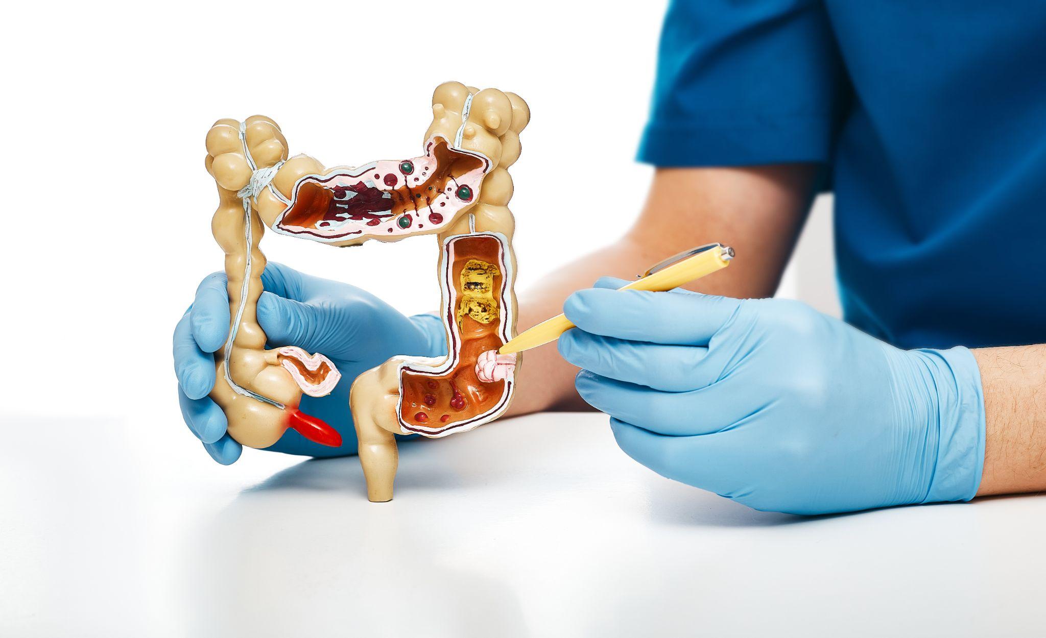 80% dos casos de câncer de intestino podem ser evitados com exames de rotina, alerta especialista