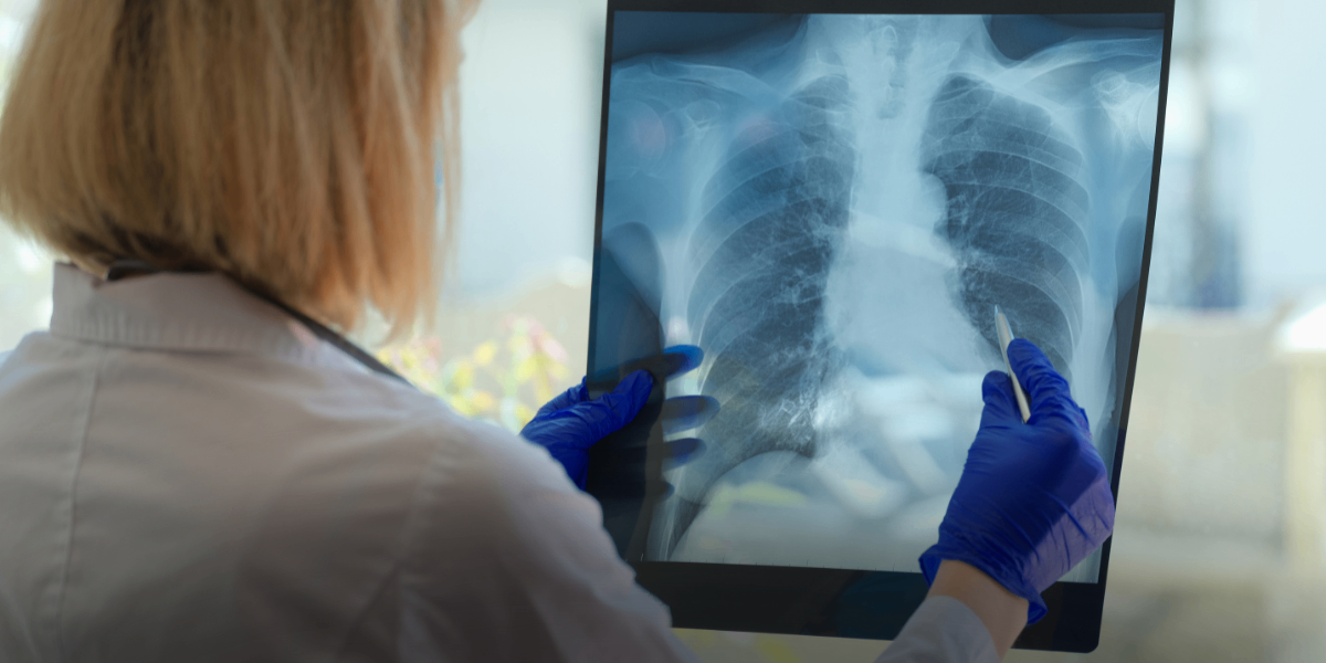 Câncer de pulmão: como a detecção precoce e o cirurgião torácico fazem a diferença